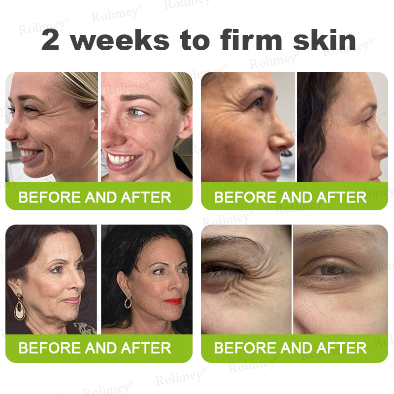 👏🌿Proudly Made in the UK💫Rolimey® Botox & Vita-A Retinol Shot Wrinkle-Lift Tightening cream - Last Day Promotion 70% OFF⏰⏰