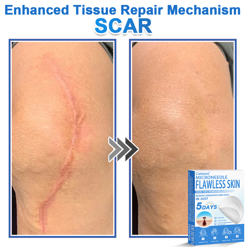 Celsiora®✅2-in-1 Microneedle & Hydrocolloid Patch | Raised Moles,Acne,  Flat Warts & Skin Tags Remover | Improves Wrinkles, Scars & Blemishes | Invisible Pimple Patches for Face & Body