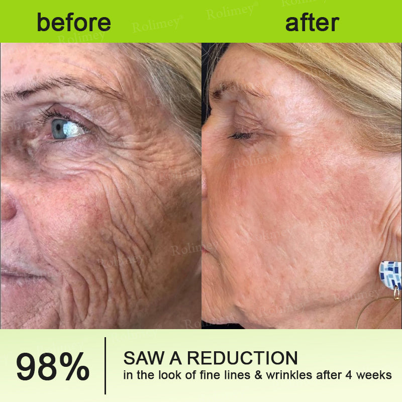 👏🌿Proudly Made in the UK💫Rolimey® Botox & Vita-A Retinol Shot Wrinkle-Lift Tightening cream - Last Day Promotion 70% OFF⏰⏰