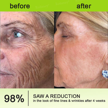 👏🌿Proudly Made in the UK💫Rolimey® Botox & Vita-A Retinol Shot Wrinkle-Lift Tightening cream - Last Day Promotion 70% OFF⏰⏰