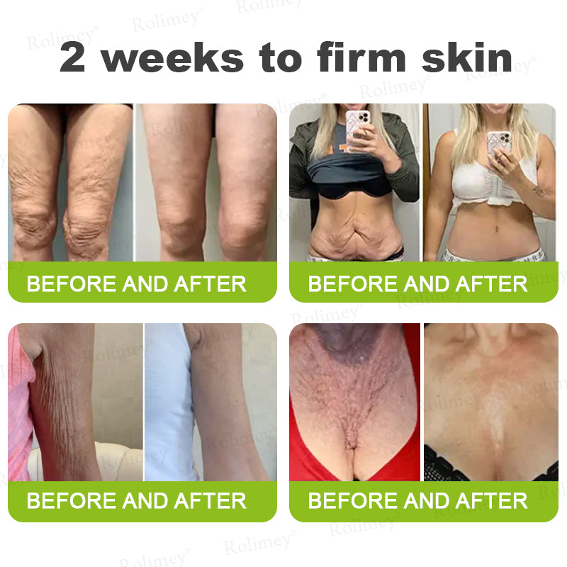 👏🌿Proudly Made in the UK💫Rolimey® Botox & Vita-A Retinol Shot Wrinkle-Lift Tightening cream - Last Day Promotion 70% OFF⏰⏰
