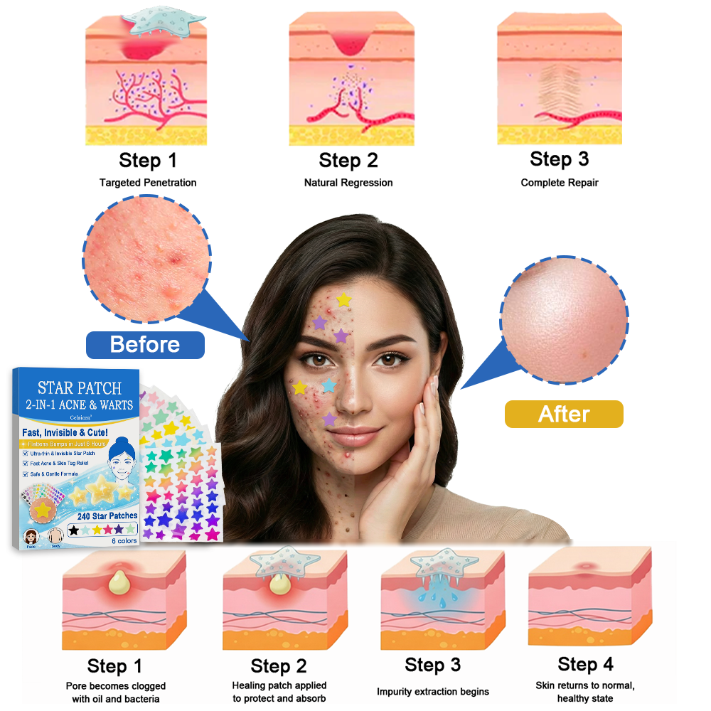 ✔Celsiora® 2-in-1 Microneedle & Hydrocolloid Star Patch | Acne, Raised Moles, Flat Warts & Skin Tags Remover | 6 Colors Pimple Patch for Face & Neck | Invisible Star Zit Stickers | 240 Count