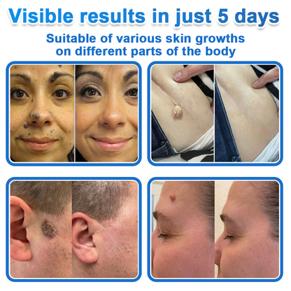 Celsiora®✅2-in-1 Microneedle & Hydrocolloid Patch | Raised Moles,Acne,  Flat Warts & Skin Tags Remover | Improves Wrinkles, Scars & Blemishes | Invisible Pimple Patches for Face & Body