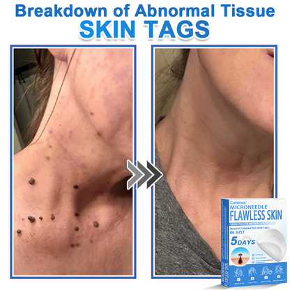 Celsiora®✅2-in-1 Microneedle & Hydrocolloid Patch | Raised Moles,Acne,  Flat Warts & Skin Tags Remover | Improves Wrinkles, Scars & Blemishes | Invisible Pimple Patches for Face & Body