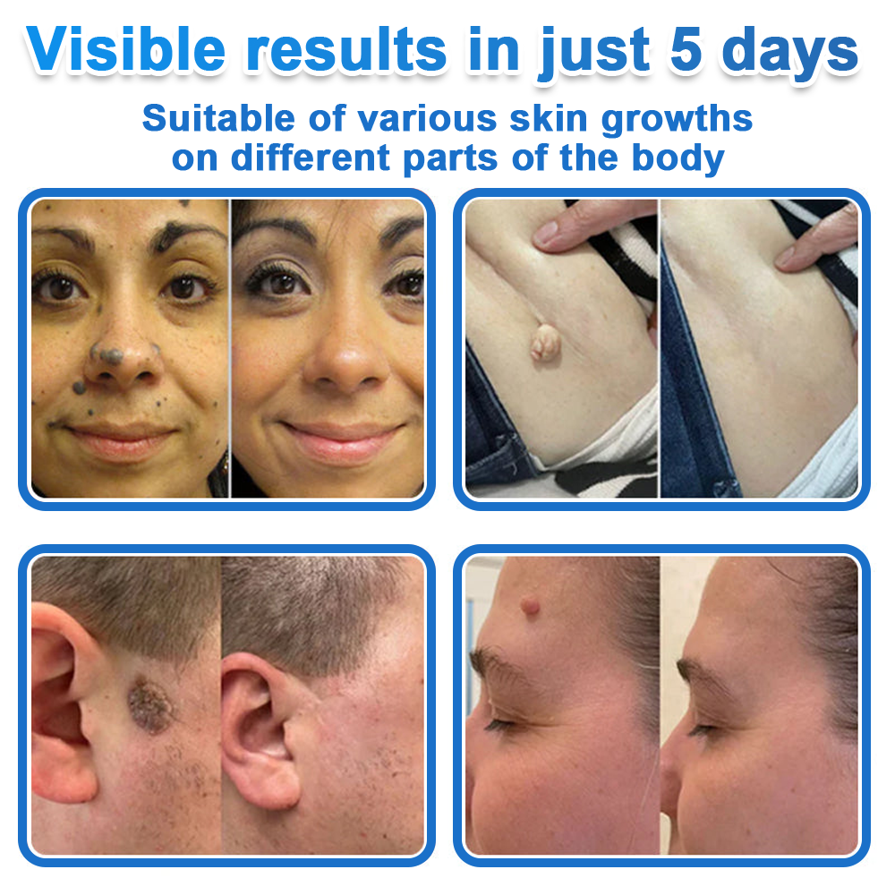 💫 Celsiora® 2-in-1 Microneedle & Hydrocolloid Patch | Raised Moles,Acne,  Flat Warts & Skin Tags Remover | Improves Wrinkles, Scars & Blemishes | Invisible Pimple Patches for Face & Body