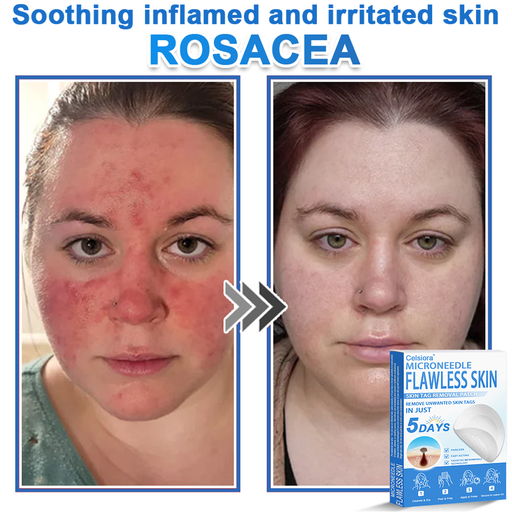 💫 Celsiora® 2-in-1 Microneedle & Hydrocolloid Patch | Raised Moles,Acne,  Flat Warts & Skin Tags Remover | Improves Wrinkles, Scars & Blemishes | Invisible Pimple Patches for Face & Body