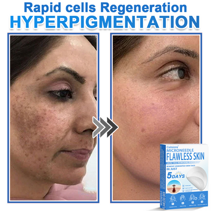 💫 Celsiora® 2-in-1 Microneedle & Hydrocolloid Patch | Raised Moles,Acne,  Flat Warts & Skin Tags Remover | Improves Wrinkles, Scars & Blemishes | Invisible Pimple Patches for Face & Body