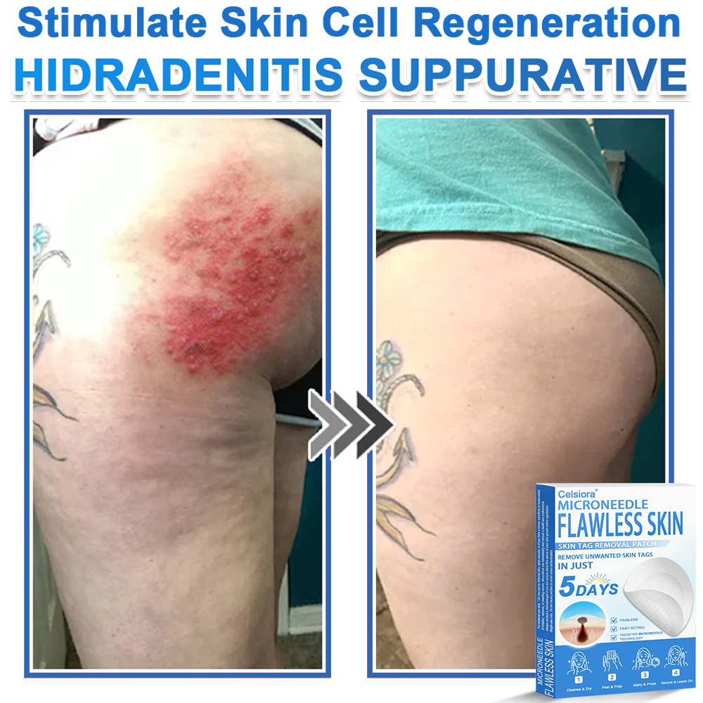 💫 Celsiora® 2-in-1 Microneedle & Hydrocolloid Patch | Raised Moles,Acne,  Flat Warts & Skin Tags Remover | Improves Wrinkles, Scars & Blemishes | Invisible Pimple Patches for Face & Body
