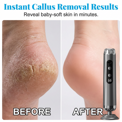 🥳2026 HOT SALE🥳💞50K+ SOLD!🌸✨ LAST DAY SPECIAL PRICE! Multi‑Function Electric Foot Grinder – 5 speeds, 50 grinding pads & LED display. Smooth tough calluses effortlessly – salon results at home! 💅🛡️